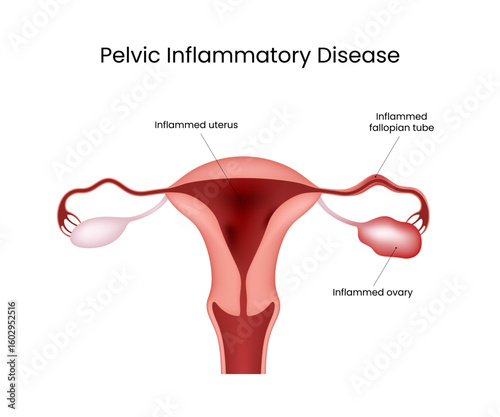 Pelvic Inflammatory Disease Anatomical Female Reproductive System
