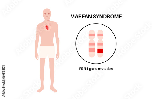 Marfan syndrome poster
