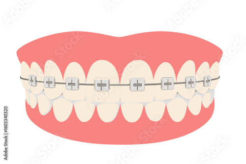 Metal braces on teeth for orthodontic treatment. Dental care concept for alignment and bite correction. Dentistry illustration of a healthy smile with a braces system. Vector.