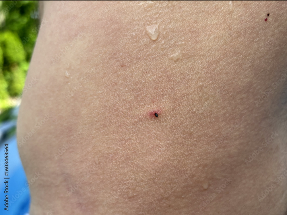 Fototapeta premium A Tick Embedded in a Mans Hip in Summer
