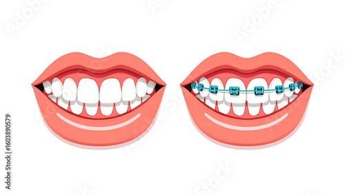 Smiling mouth with and without dental braces teeth smile