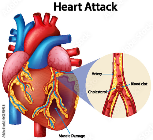 Detailed Heart Attack Medical Illustration