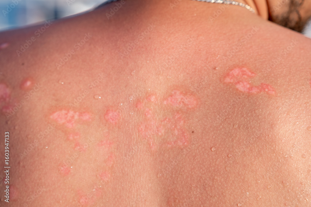 Fototapeta premium Psoriasis Patches on a Persons Back Observed During a Sunny Day at the Beach in a Coastal Location