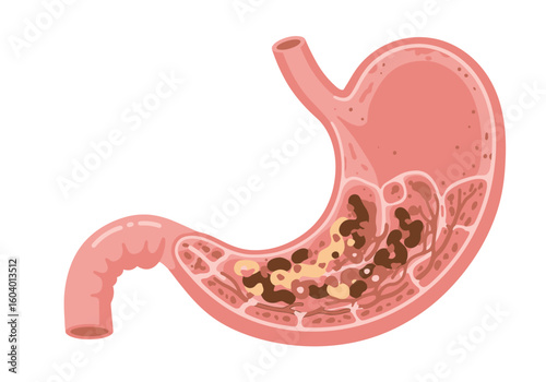 Crosssection view of stomach with contents showing anatomy and partially digested food