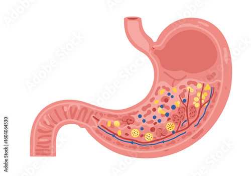 Cutaway illustration of a stomach with yellow and blue contents