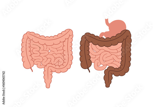 Two human digestive systems one healthy and one unhealthy