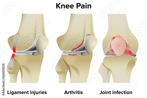 Knee ligament injuries, arthritis and injuries, knee pain concept medical illustration 