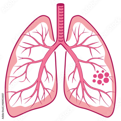 Lungs reveal disease as a growth appears on the lower lobe in pink