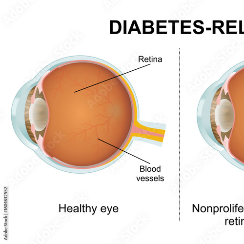 Diabetes-related Retinopathy