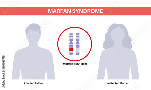 Marfan syndrome poster