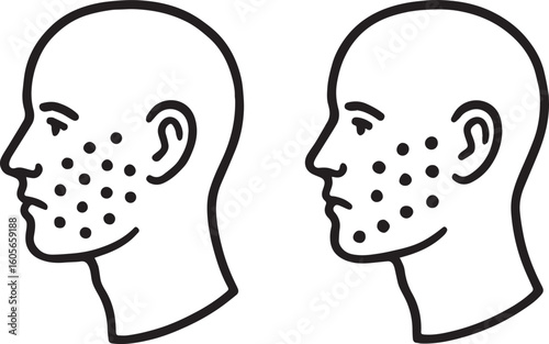 Side profile comparison of a clean face and an acne affected face with facial dots, showing the difference in skin conditions and acne visibility acne skin problem icon
