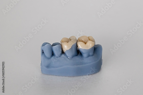 Konstfotografi Close-up of blue dental cast showing tooth inlays and onlays