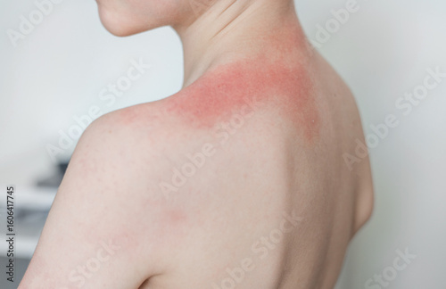 Preschool child with sun allergy and red burned skin on arm, shoulder, and chest. Small bumps and blisters under armpit. Kid scratching due to excessive sun exposure.