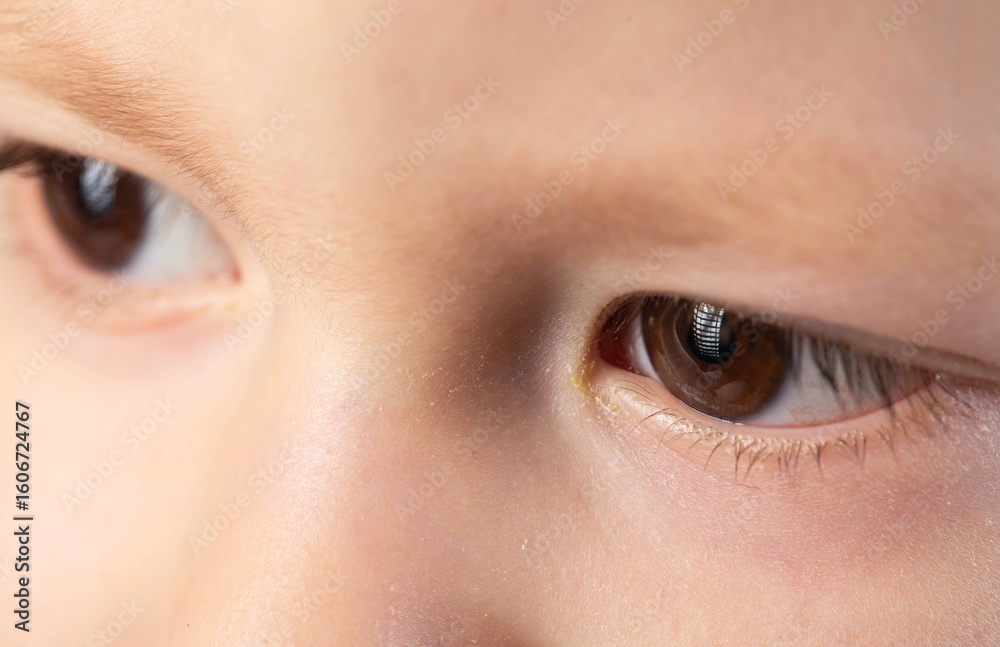 Fototapeta premium Bacterial infection in the eyes of a little boy, conjunctivitis, pus in the eyes, close-up