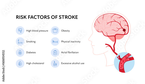 Brain neural disease for healthcare infographic. Vector flat illustration. Risk factors of stroke poster and icon set. Design for health care