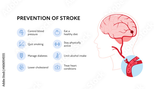 Brain neural disease for healthcare infographic. Vector flat illustration. Prevention of stroke poster and icon set. Design for health care