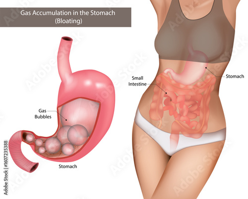 Gas Accumulation in the Stomach (Bloating). Mechanism and Location of Discomfort. Medical Illustration of Stomach Gas Buildup