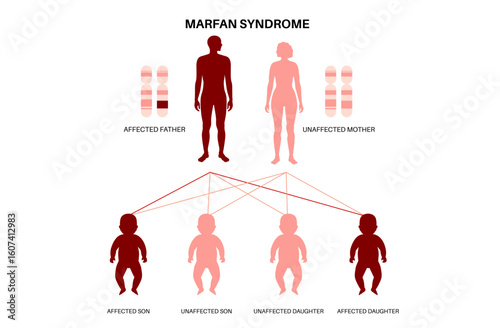 Marfan syndrome poster