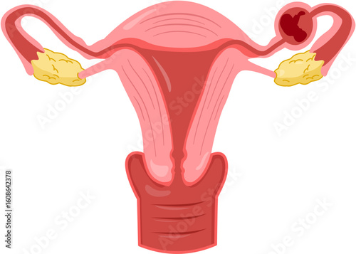 Ectopic pregnancy 