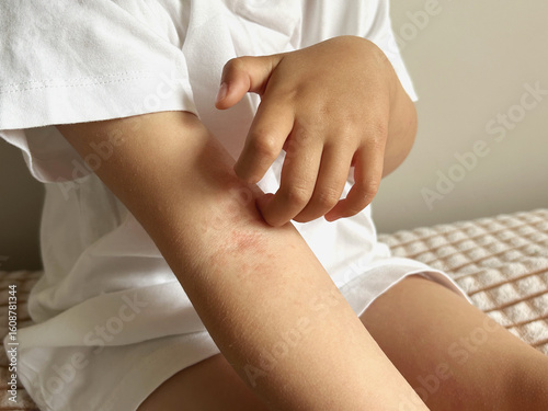Child scratching irritated skin on arm due to rash or allergy