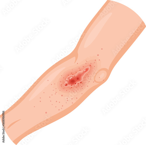 Illustration of skin rash on a human forearm, showing a red, inflamed area near the elbow.