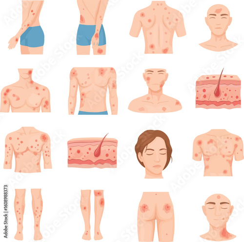Illustrations depicting various views of human bodies affected by skin conditions.
