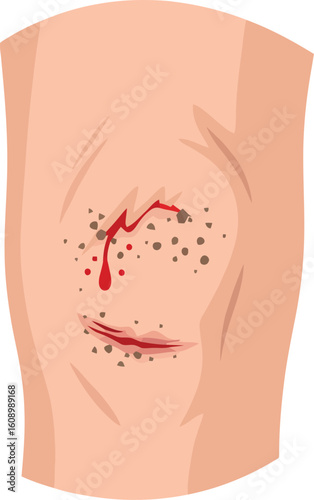 A cartoon illustration of a scraped knee with blood and dirt.