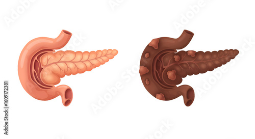 Healthy versus diseased pancreas comparison; anatomical illustration showing healthy and inflamed pancreatic tissue.