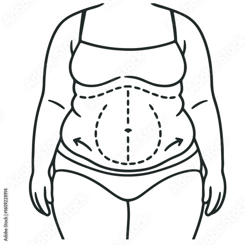 Abdominoplasty Illustration Body Contouring