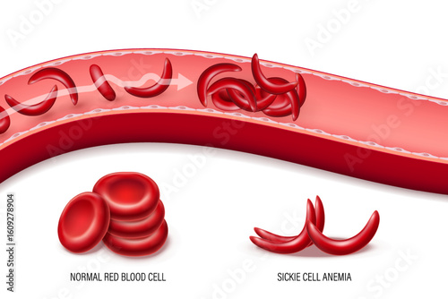 Sickle cell disease. Normal red blood cells and sickled red blood cells. Sickle cell anemia.