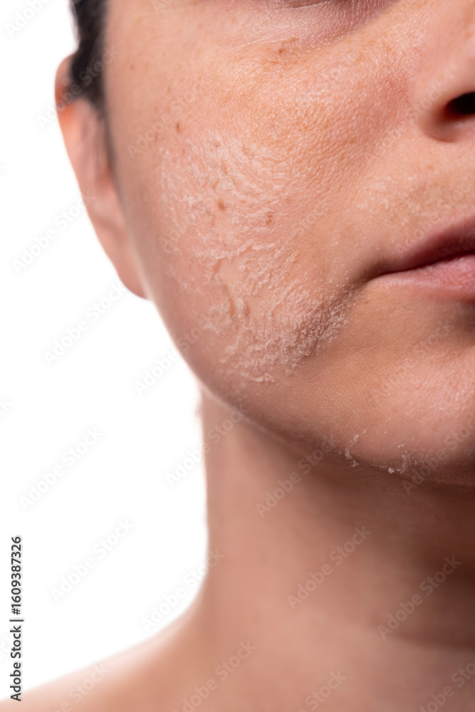 Obraz premium Woman peeling facial skin – Skincare treatment concept – Female face with flaky skin after exfoliation