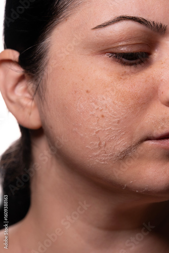 Photography Woman peeling facial skin – Skincare treatment concept – Female face with flaky
