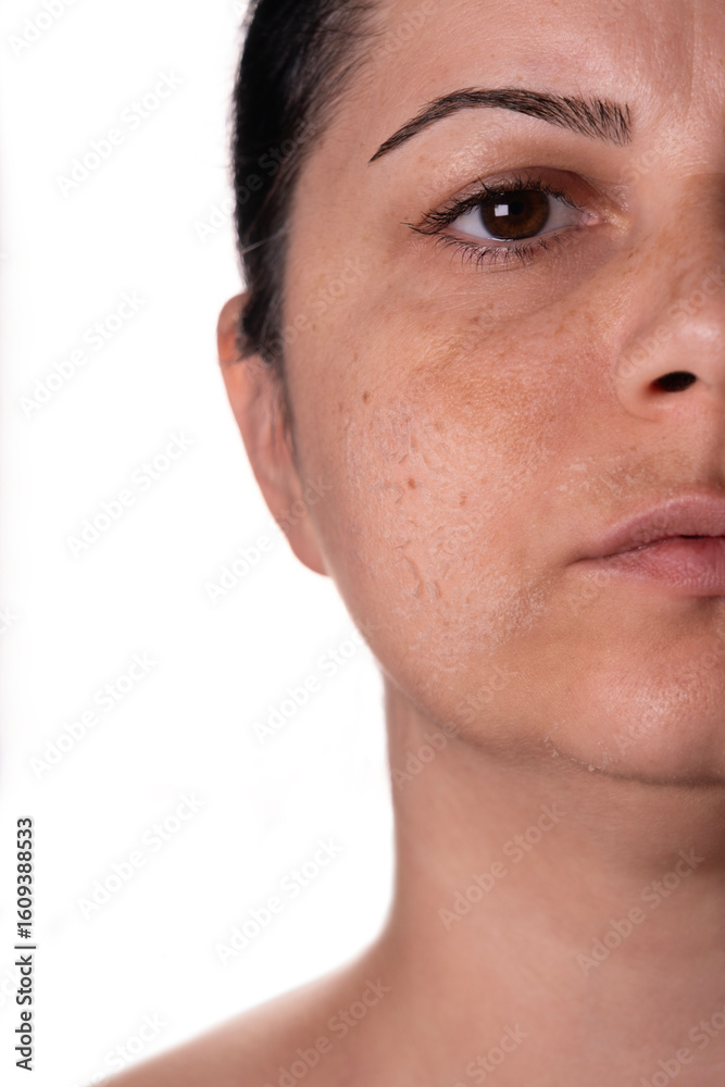 Fototapeta premium Woman peeling facial skin – Skincare treatment concept – Female face with flaky skin after exfoliation