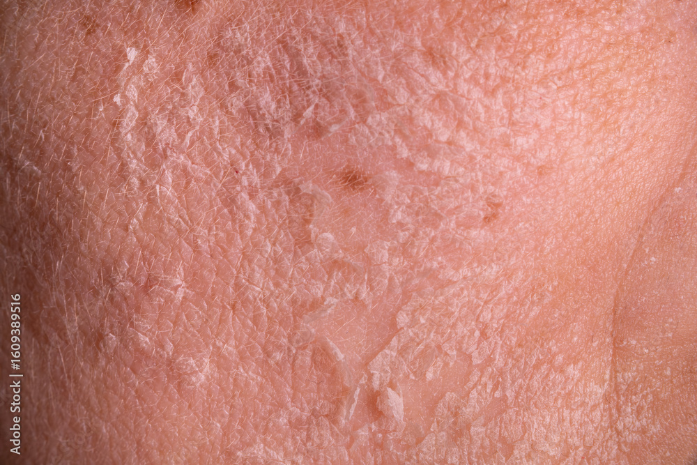 Fototapeta premium Skin shedding and regeneration close-up – Dermatology concept – Peeling human skin