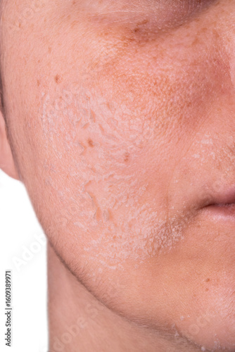 Woman peeling facial skin – Skincare treatment concept – Female face with flaky skin after exfoliation