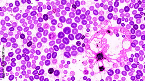 Histopathology of bacterial abscess,
neutrophil infiltration (multi-lobed nuclei),
central necrosis with ghost cells.