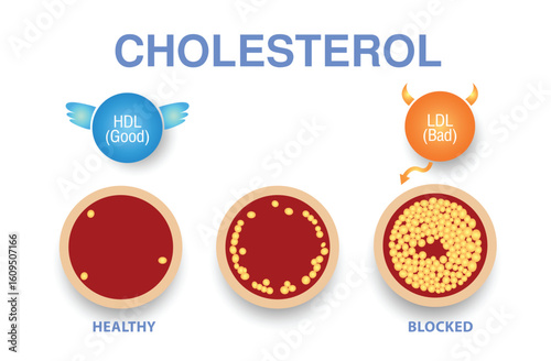 Cholesterol in artery, health risk
