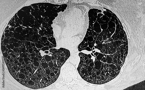 Medical themes: CAT- Scan of Lynphangiomatosis in a young female.
