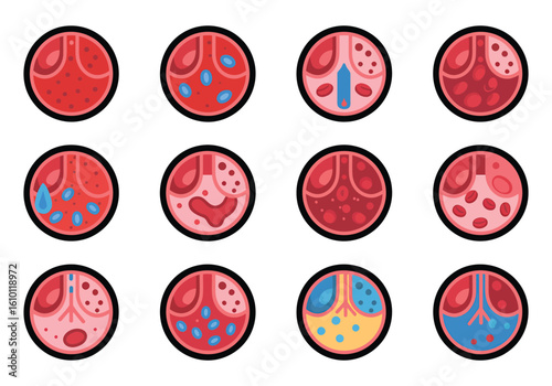 Progression of Artery Disease Atherosclerosis Stages of Blocked Blood Vessels Medical Diagram Showing Plaque Formation and Blood Flow Reduction Cardiovascular Health Illustration