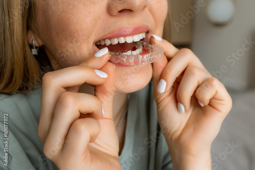 Woman inserting a clear aligner for orthodontic treatment and teeth correction