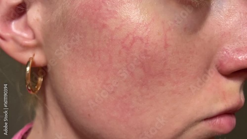 Macro close-up of woman’s cheek with visible broken capillaries, facial redness, rosacea and texture. Dermatology concept, natural condition, untreated skin.