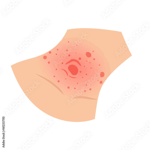 Vector illustration of contact dermatitis symptoms on white background, medical and skin care concept