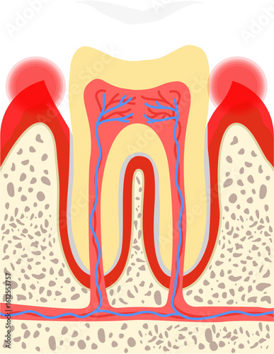 Gingivitis 