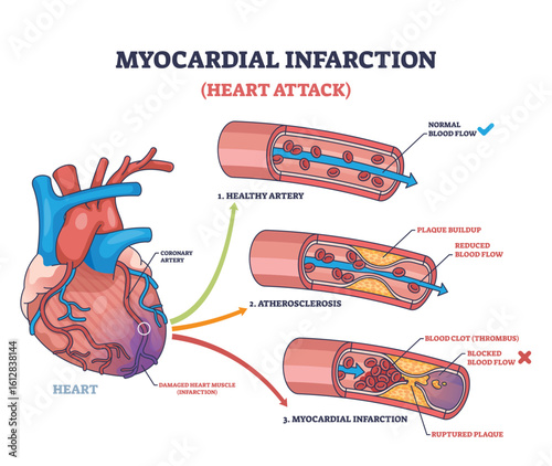 Myocardial infarction shows a heart with arteries, plaque buildup, and blood clot, illustrating heart attack causes. Outline diagram