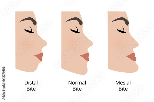 Distal, normal and mesial bite comparison showing malocclusion and correct teeth position