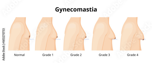 Gynecomastia Stages Showing Different Breast Sizes