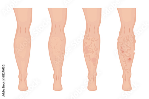Stages of varicose veins developing on human leg