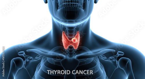 Close up of a human neck showing the thyroid gland highlighted in red to represent thyroid cancer isolated on transparent background
