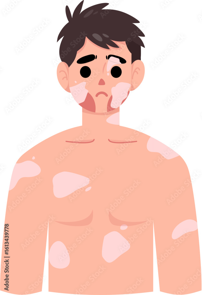 Fototapeta premium Vitiligo 