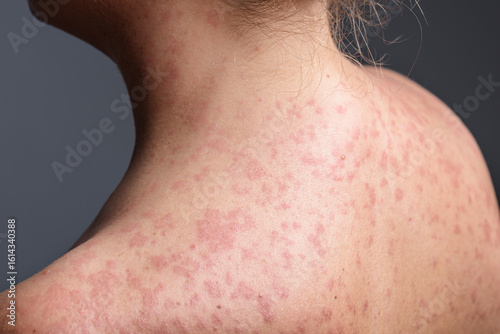 A woman with a red, spotty rash caused by measles.